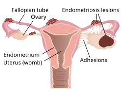 Diagram of uterus with endometriosis on Fallopian tubes and an endometrioma in the right ovary. Adhesions connect the right ovary to the uterus.
