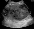 A very large (9&nbsp;cm) fibroid of the uterus, which is causing pelvic congestion syndrome as seen on ultrasound