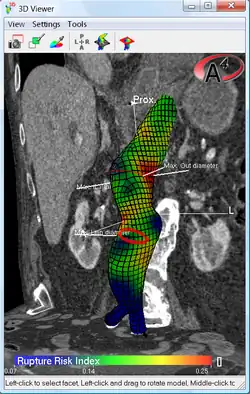 Biomechanical AAA rupture risk prediction