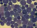 Bone marrow smear (large magnification) from a person with ALL