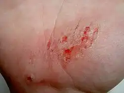 Abrasion on hand
