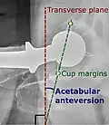 Acetabular anteversion.[111] This parameter is calculated on a lateral radiograph as the angle between the transverse plane and a line going through the (anterior and posterior) margins of the acetabular cup.[111]