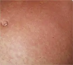 Typical fine-spotted pink rash of acute African trypanosomiasis on the skin of the abdomen ("trypanid rash")[18]