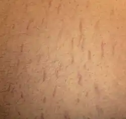 Fuzzy red lines on an abdomen
