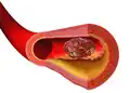 Illustration depicting thrombus formation over arterial plaque.