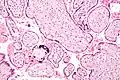 Micrograph of a placental infection (CMV placentitis)