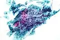 Candida organisms on a pap test