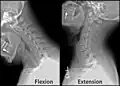 X-ray of cervical spine in flexion and extension
