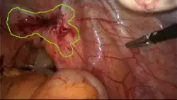 Larger red lesion in peach-colored background