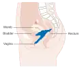 Stage 4A cervical cancer