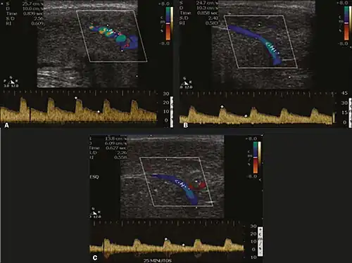 Longitudinal, ventral ultrasound of the penis, with pulsed mode and color Doppler. Flow of the cavernous arteries at 5, 15, and 25 min after prostaglandin injection (A, B, and C, respectively). The cavernous artery flow remains below the expected levels (at least 25–35&nbsp;cm/s), which indicates ED due to arterial insufficiency.[49]
