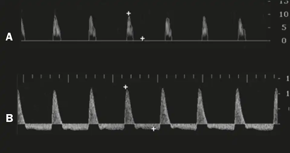 Graphs representing the color Doppler spectrum of the flow pattern of the cavernous arteries during the erection phases. A: Single-phase flow with minimal or absent diastole when the penis is flaccid. B: Increased systolic flow and reverse diastole 25 min after injection of prostaglandin.[49]