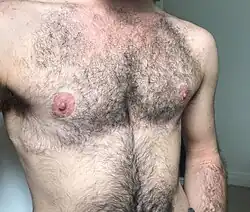 Haired chest of a transgender man with healed double incision chest reconstruction, 2020