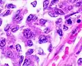 Nuclear grade 3: Markedly enlarged and pleomorphic nuclei, with coarse chromatin and distinct nucleoli.[65]