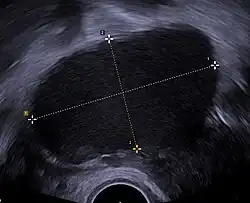 Transvaginal ultrasonography showing a 67 x 40&nbsp;mm endometrioma, with a somewhat grainy content