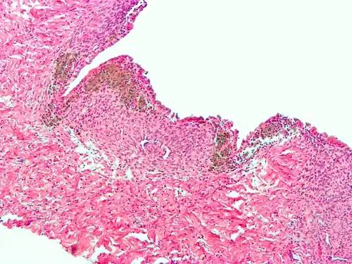 Microscope image of an endometrioma with all features of endometriosis: endometrial glands (dark purple), endometrial stroma (light purple), and iron in macrophages (brown)