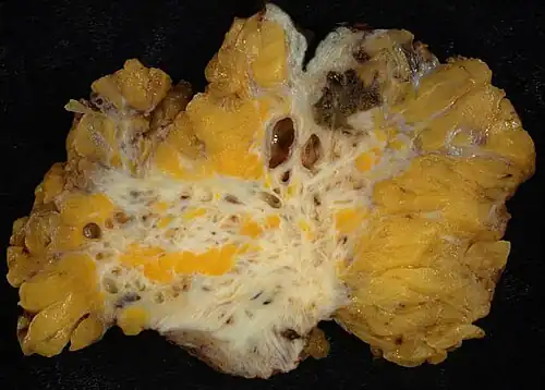 Lump of fat interlaced with fibrous bands and dark spots