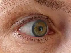 Closeup of the eye, showing the light tint on the rim of a corrective contact lense