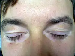Nonsegmental vitiligo of the eyelids