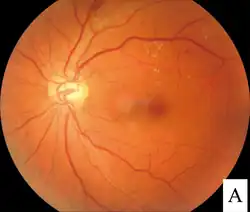 Photograph of retina after scatter laser surgery for diabetic retinopathy.