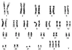 A karyotype, or image of chromosomes, for tetrasomy X. The chromosomes are labelled 1 to 22 for the autosomes (non-ryotype of tetrasomy X)
