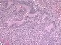 Pseudopalisading seen around necrosis in glioblastoma