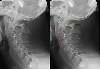 X-ray of the cervical spine, with and without annotation, demonstrating the relative locations of the C2 and C3 vertebrae following a typical break as would be caused by a hangman's noose