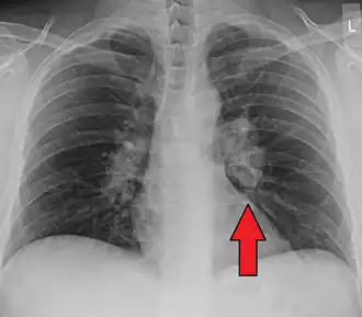 Hilar adenopathy, especially on the person's left (AP CXR)