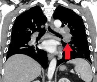 Hilar adenopathy, especially on the person's left (coronal CT)