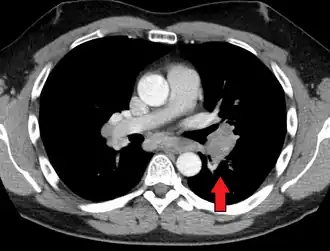 Hilar adenopathy, especially on the person's left (transverse CT)
