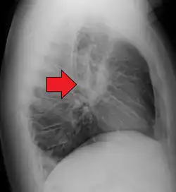 Hilar adenopathy, especially on the person's left (lateral CXR)