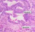 Grade 1: ≤5% solid non-glandular, non-squamous growth.[64]