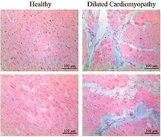 Healthy myocardium versus interstitial fibrosis in dilated cardiomyopathy. Alcian blue stain.