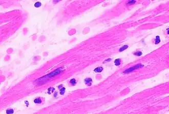 Neutrophils are seen in a myocardial infarction at approximately 12–24 hours,[69] as seen in this micrograph.