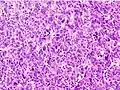 Poorly differentiated HCC