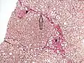 Histopathology of steatohepatitis with moderate fibrosis, with thin fibrous bridges (Van Gieson's stain)[96]