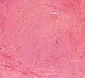 Histopathology of uterine fibroids typically show smooth muscle in a whorled (fascicular) pattern.[40]