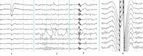 Main types of artifacts in human EEG