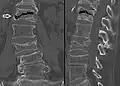 The intravertebral vacuum cleft sign (at white arrow) is a sign of avascular necrosis. Avascular necrosis of a vertebral body after a vertebral compression fracture is called Kümmel's disease.[20]