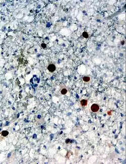 Immunohistochemical detection of human polyomavirus 2 protein (stained brown) in a brain biopsy (glia demonstrating progressive multifocal leukoencephalopathy