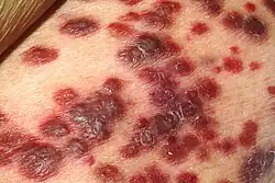 Multiple dark red skin lesions