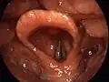 Structures of the larynx as viewed during laryngoscopy. The leaf-like epiglottis is shown as number '3'. Other structures: 1=vocal folds, 2=vestibular fold, 3=epiglottis, 4=plica aryepiglottica, 5=arytenoid cartilage, 6=sinus piriformis, 7=dorsum of the tongue.