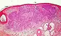 Cohesive nodular