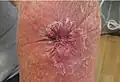 Melanoma left forearm post excision with purse-string closure