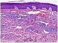 Micrograph of plaque stage, with bizarre vessels dissecting the upper dermis. There is erythrocyte extravasation and hemosiderin pigmentation.[16]