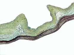 micrograph of aortic regurgitation