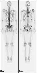 A nuclear medicine whole body bone scan. The nuclear medicine whole body bone scan is generally used in evaluations of various bone-related pathology, such as for bone pain, stress fracture, nonmalignant bone lesions, bone infections, or the spread of cancer to the bone.