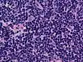 Mantle cell lymphoma: Notice the irregular nuclear contours of the medium-sized lymphoma cells and the presence of a pink histiocyte. By immunohistochemistry, the lymphoma cells expressed CD20, CD5, and Cyclin D1 (high-power view, H&E).