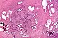 Micrograph showing nodular hyperplasia (left off center) of the prostate from a transurethral resection of the prostate (TURP). H&E stain.