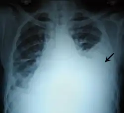 Massive pleural effusion, later proven to be hemothorax, in a South Indian male